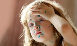 Ветряная оспа в курсе, что с «короной» Минздрав накосячил — и бесчинствует в российских регионах