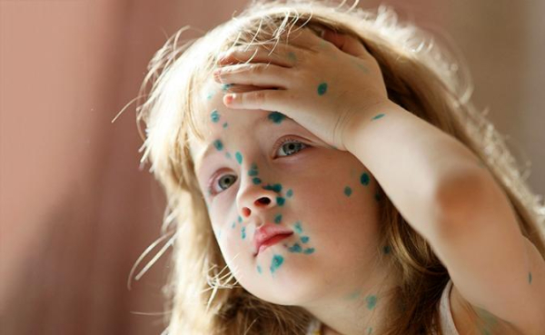 Ветряная оспа в курсе, что с&nbsp;&laquo;короной&raquo; Минздрав накосячил&nbsp;&mdash; и бесчинствует в российских регионах