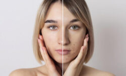 Почему стресс и нарушение сна могут вызывать акне